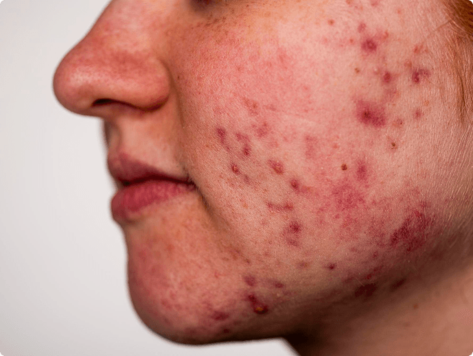 Acne huidprobleem